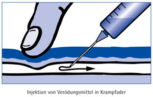 injektion-in-krampfader.jpg